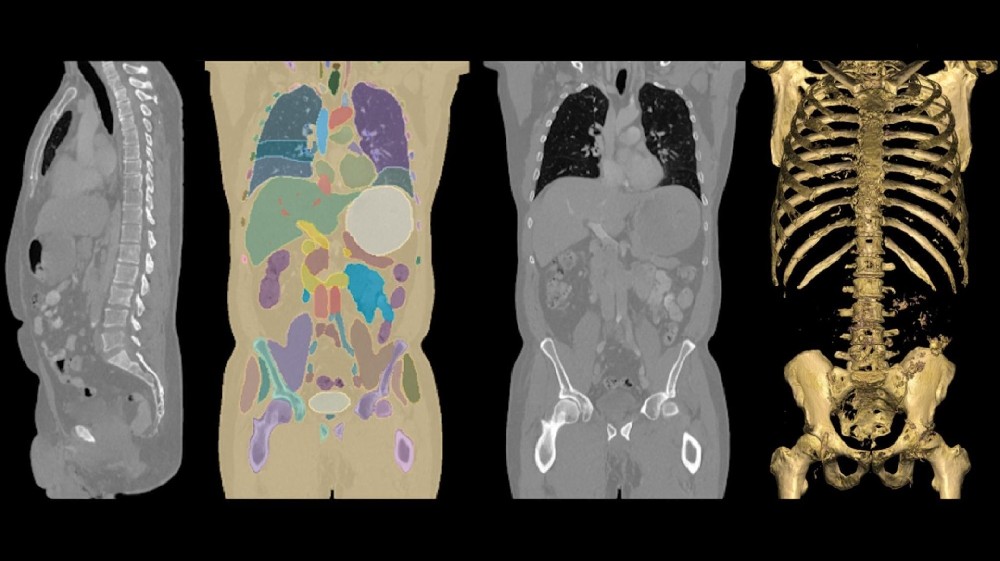 MONAI Core v1.4, VISTA-3D and MAISI for Medical AI Workflows